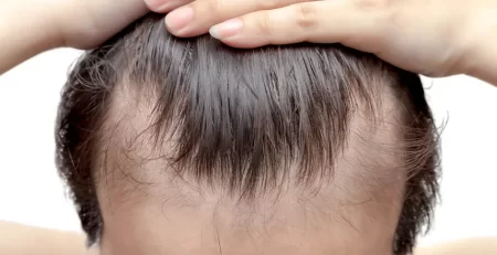 minoxidil-hair-care-routine