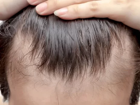 minoxidil-hair-care-routine